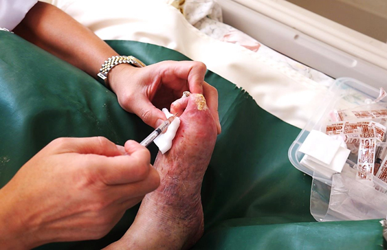 At Nishihara Clinic in Japan, Lee Seong-hee, the Chairman of the Buerger’s Disease Patients Association, is currently receiving treatment for necrosis in his feet, with injections of his own stem cells.