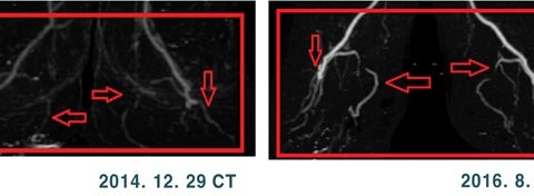 5 severe Buerger’s disease patients recruited, remarkable blood vessel regeneration shown after stem cell treatment